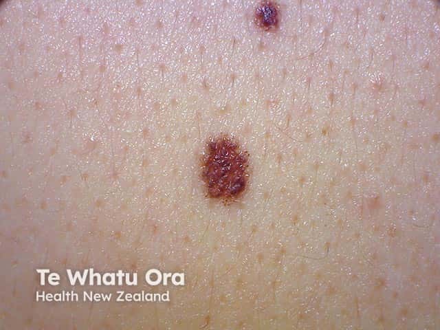 A dark macule on the central back - an in situ melanoma