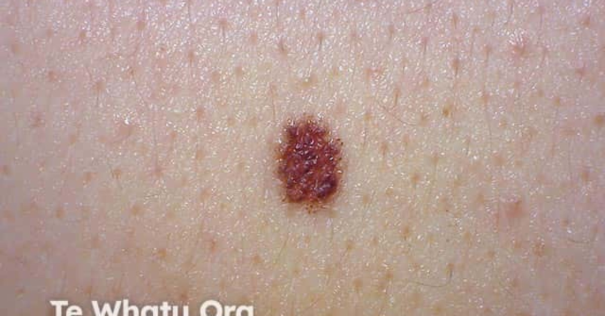 DermNet® - Melanoma in situ image