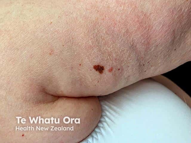 An irregularly marginated, notched and irregularly pigmented lesion on the arm - an in situ melanoma