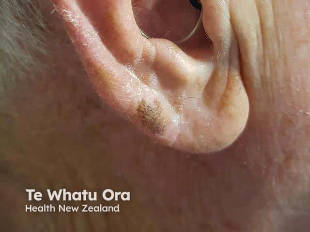 An in situ melanoma on the ear lobe - note slight irregularity of margin
