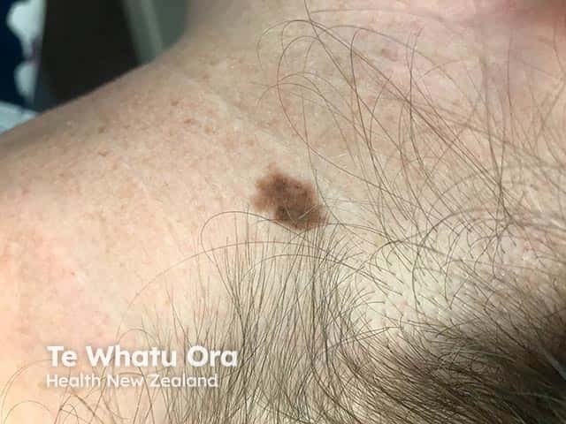An in situ melanoma showing irregularity of the pigment and margin