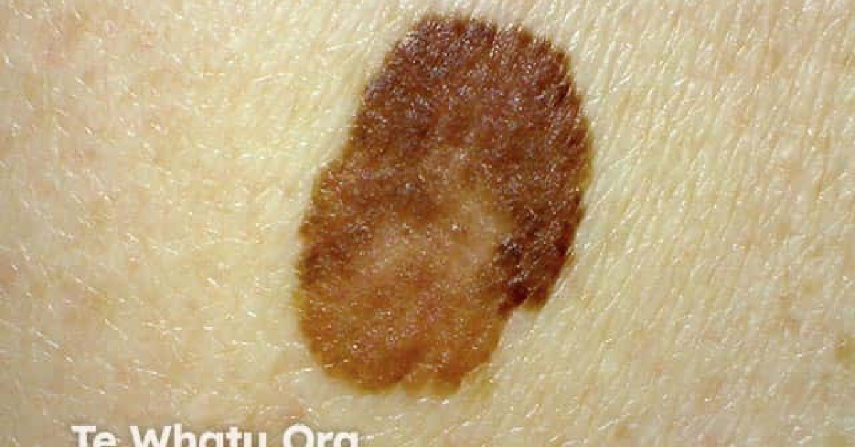 Melanoma In Situ Image