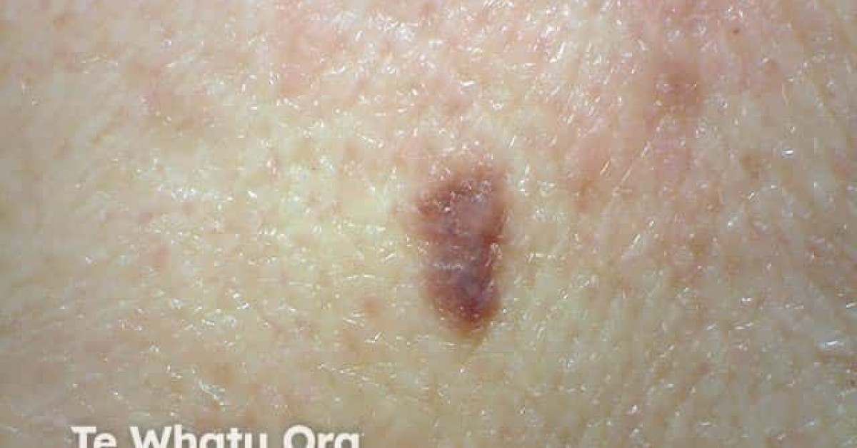 Melanoma in situ image