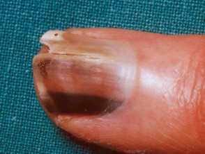 25YearOld Had a Streak on Her Nail It Turned Out to Be Skin Cancer