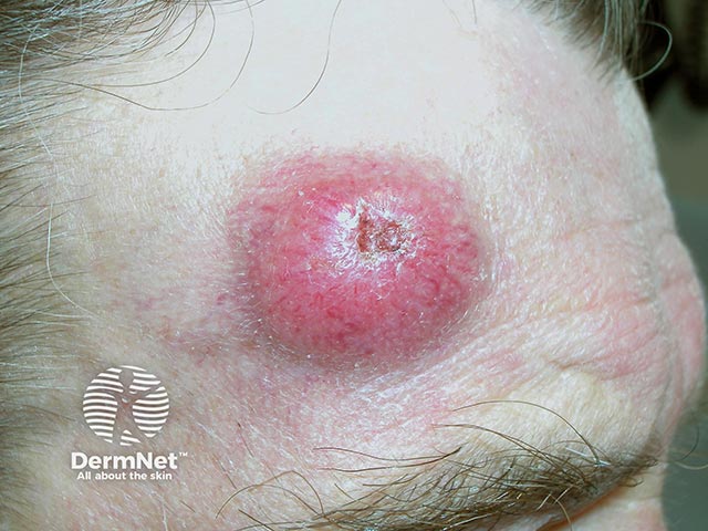 A large Merkel cell tumour with central ulceration in a patient with CLL