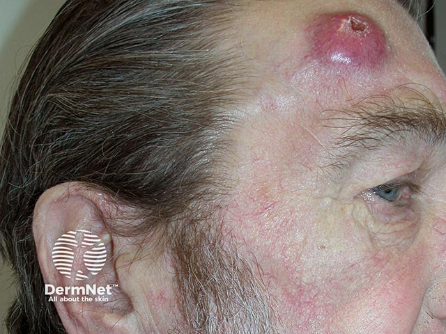 A large Merkel cell tumour with central ulceration in a patient with CLL