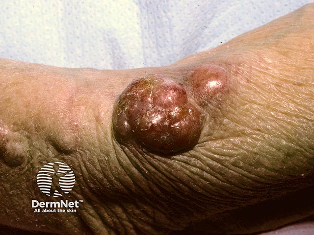 A Merkel cell tumour on the arm with satellite nodules