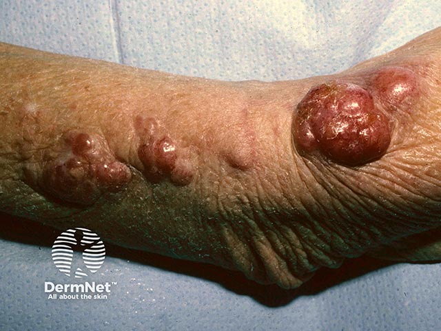 A Merkel cell tumour on the arm with satellite nodules