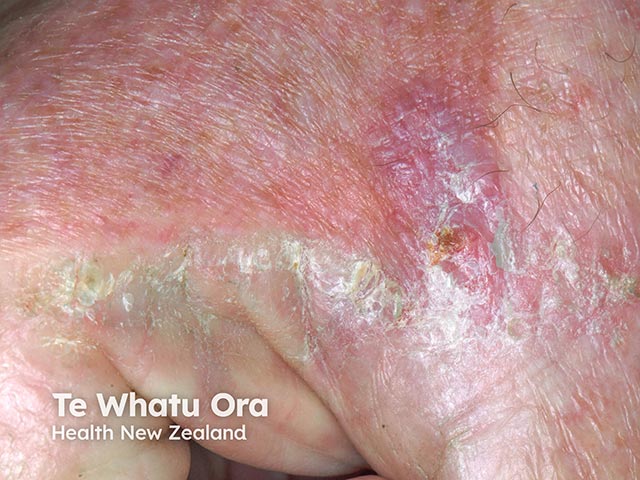 A Merkel cell tumour on the dorsal hand