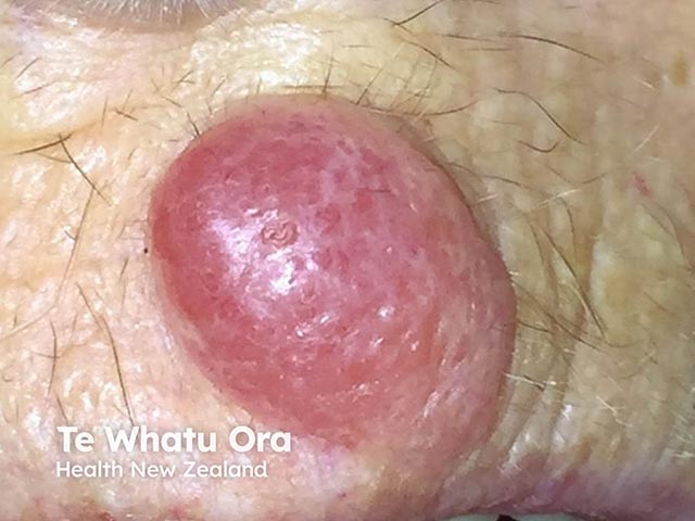 A Merkel cell tumour on the lip