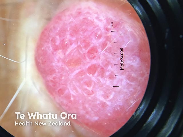 Dermoscopy of a Merkel cell tumour on the lip