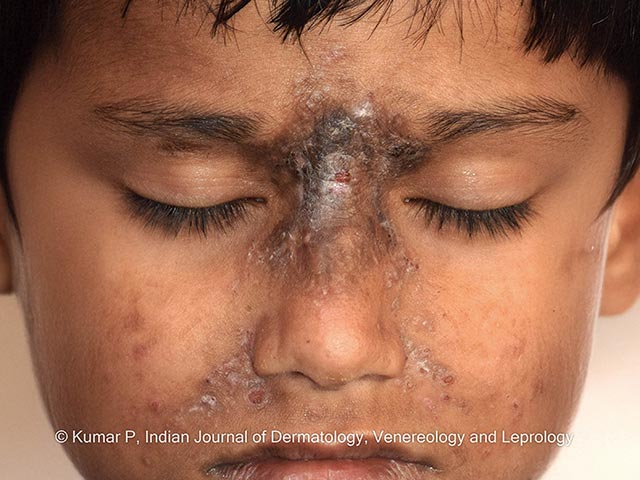 Excoriations and lichenification over the nasal bridge in mid-facial toddler excoriation syndrome