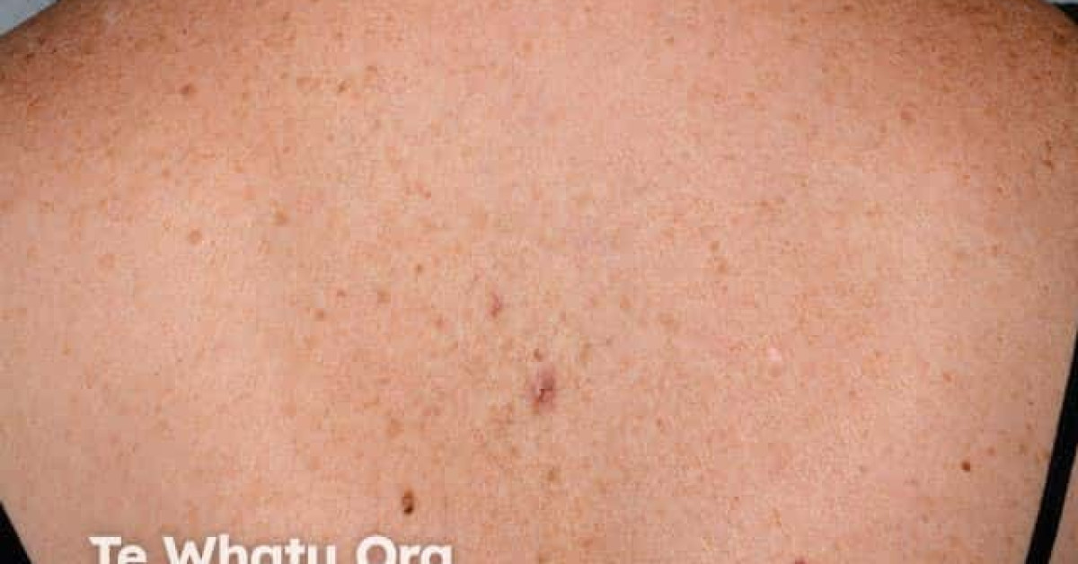 Mixed epithelioid and spindle cell melanoma image