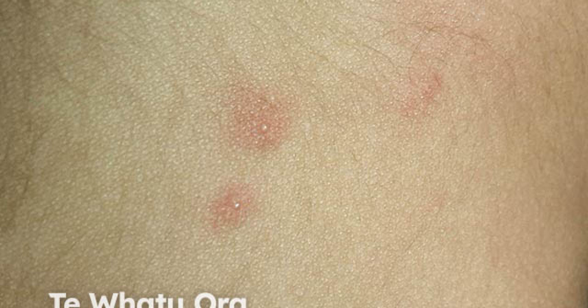 Molluscum Contagiosum Image