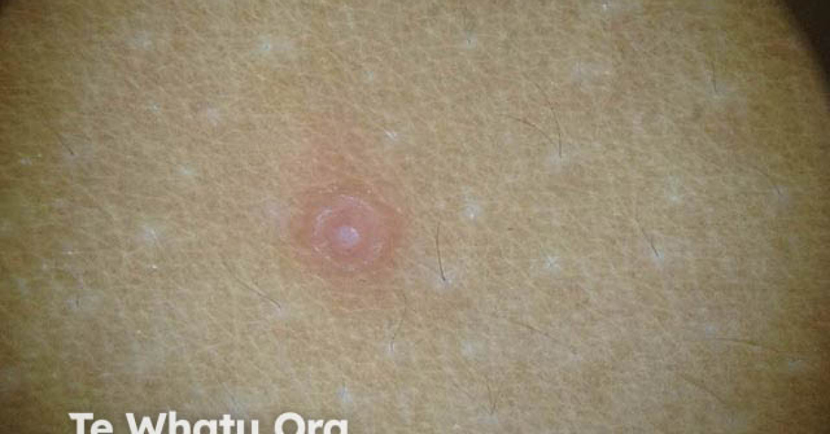 DermNet® - Molluscum contagiosum image