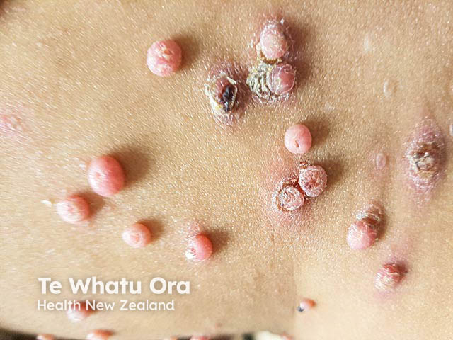 Close-up of muliple mollusca - umbilication, inflammation, and surrounding eczema can be seen
