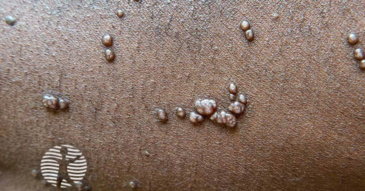 Molluscum contagiosum image