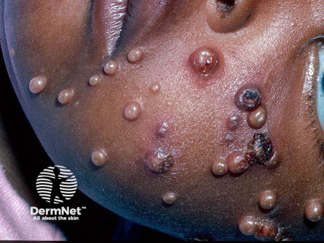 An extensive infection with mollusca - lesions often become inflamed and haemorrhagic before resolving