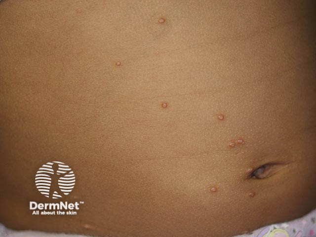 Pearly umbilicated papules typical of molluscum contagiosum on the abdomen