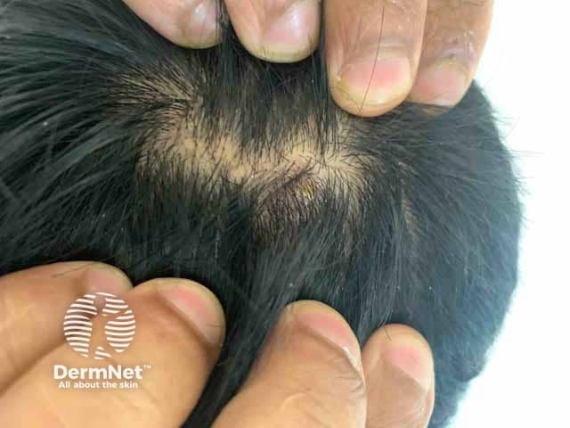 Crusted scalp papule on day 4 of monkeypox infection