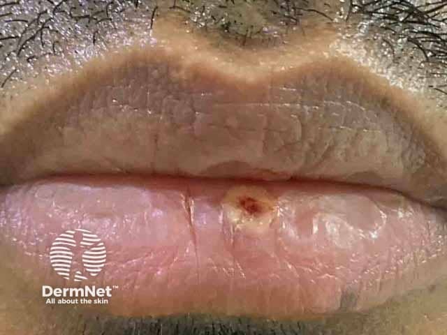 Umbilicated vesicle on lip at day 4 of infection