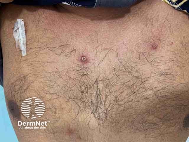 Chest lesions on day 4 of monkeypox infection