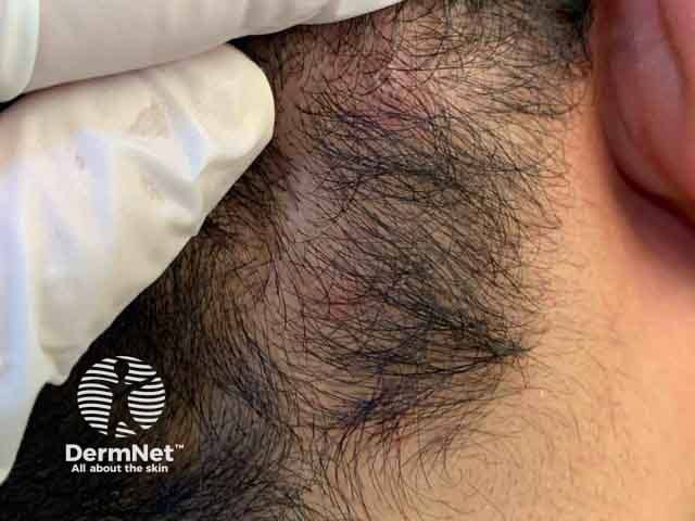 Early vesicular lesion in the beard area on the first day of infection with monkeypox