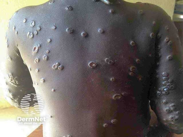 Extensive umbilicated vesicles on the trunk due to mpox in a child from an endemic area