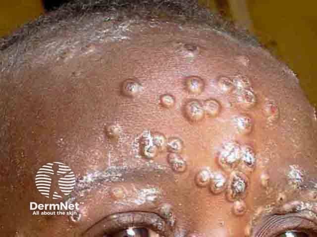 Extensive umbilicated vesicles on the forehead due to mpox in a child from an endemic area