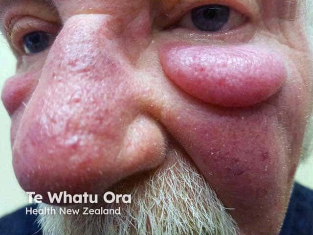 Marked lower lid lymphoedema and nasal rosacea in Morbihan disease