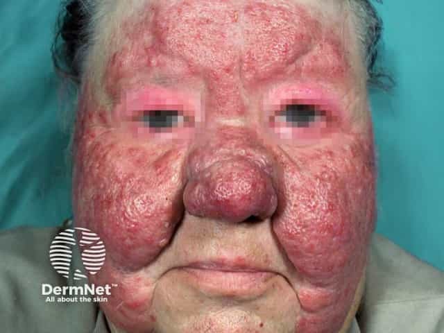 Severe extensive lymphoedema and rosacea of the forhead cheeks and lids in Morbihan disease