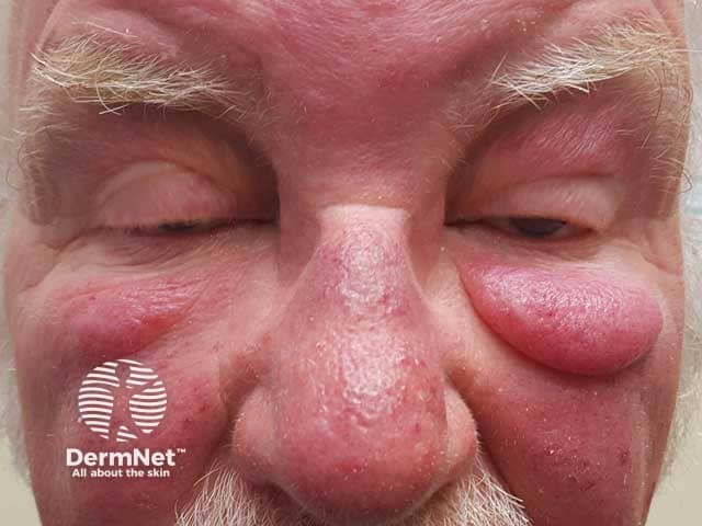 Lid lymphoedema and glabellar swelling in Morbihan disease