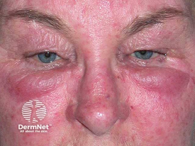 Violaceous swelling of the lower lids in Morbihan disease