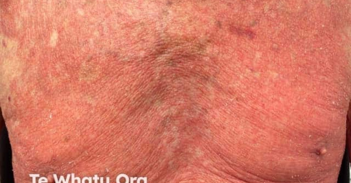 Mobillifom Rash Morbilliform drug eruption image