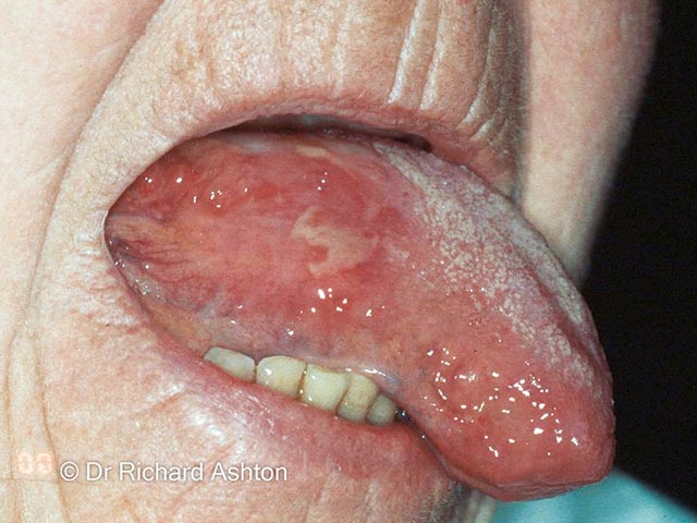 Scarring and erosions on the lateral tongue due to mucous membrane pemphigoid