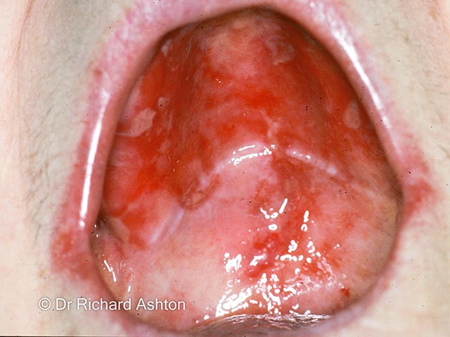 Extensive palatal erosions and scarring due to mucous membrane pemphigoid