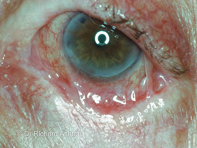 Symblepharon and conjunctival injection due to mucous membrane pemphigoid