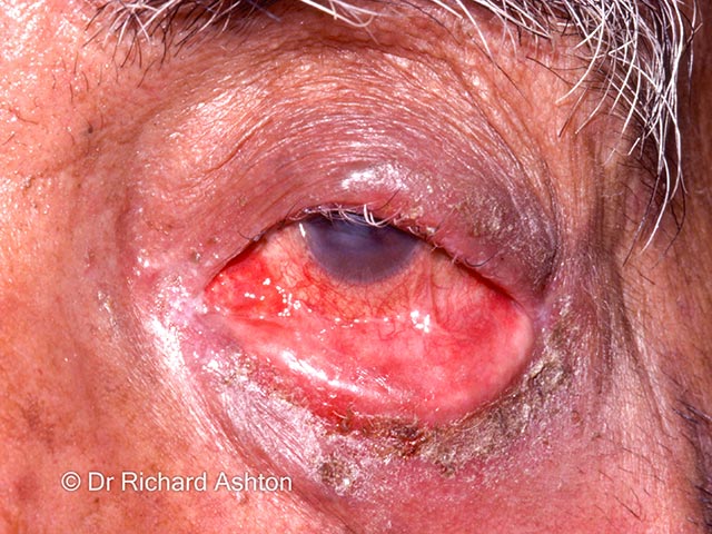 Severe inflammation and symblepharon due to mucous membrane pemphigoid