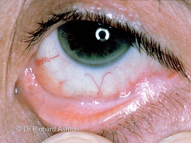 Neovascularisation of the conjunctiva and early symblepharon due to mucous membrane pemphigoid