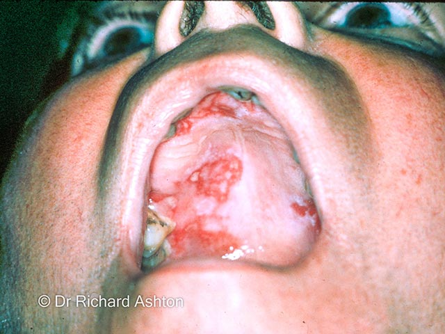 Severe palatal ulceration and scarring due to mucous membrane pemphigoid