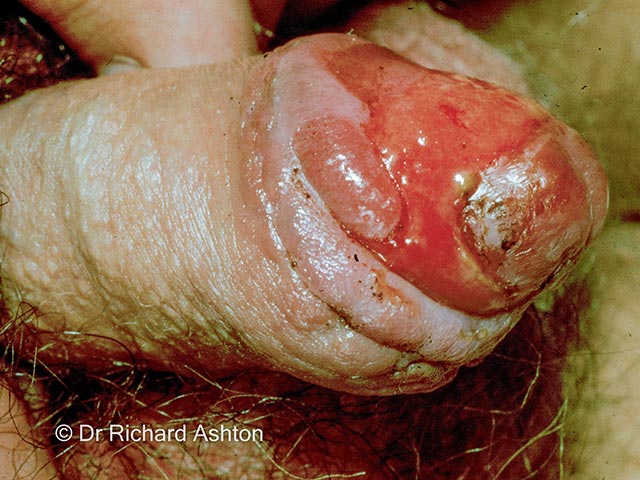 Scarring and ulceration of the glans penis due to mucous membrane pemphigoid