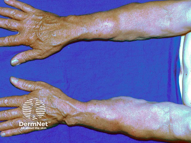 Multiple symmetrical lipomata on the arms