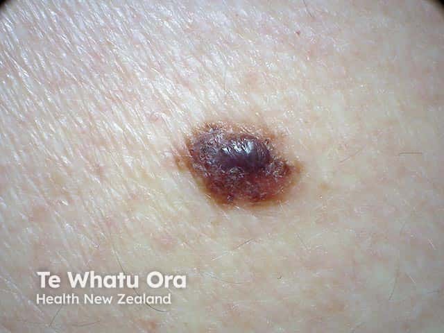 A nodule of invasive naevoid melanoma arising in a superficial spreading melanoma