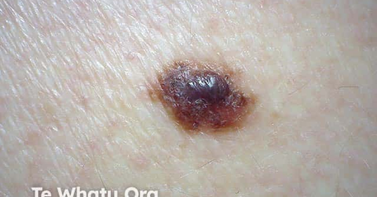 Naevoid melanoma image