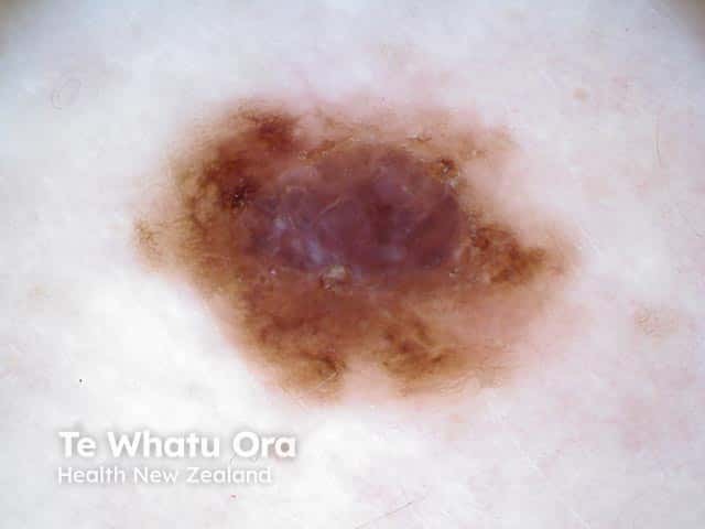 Dermoscopy of a naevoid melanoma shows a blue-grey colour and a veil arising in a superficial spreading melanoma