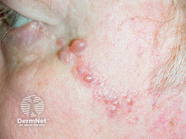 Apocrine hidrocystoma developing within a sebaceous naevus on the cheek