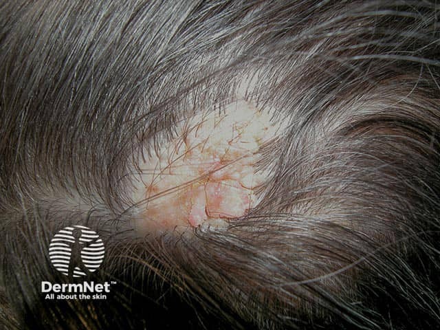A yellow verrucous hairless plaque on the occiput - a typical naevus sebaceous