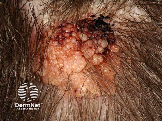 A verrucous naevus sebaceous bleeding due to hairbrush trauma
