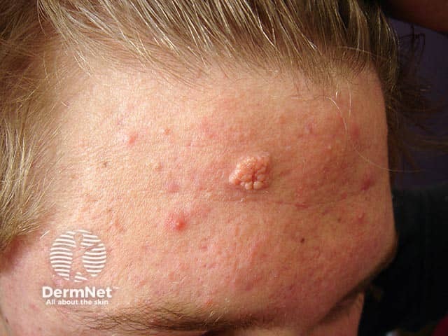 A naevus sebaceous on the forehead