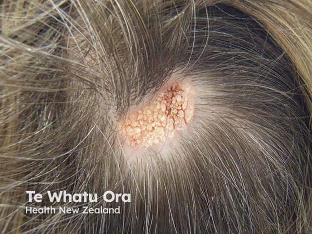 A scalp naevus sebaceous - an example of a cutaneous hamartoma